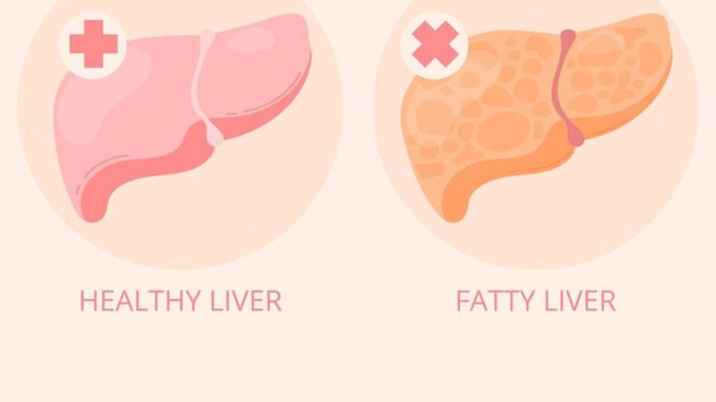 Bahaya Perlemakan Hati Fatty Liver Ancaman Senyap Yang Mengintai Kesehatan Anda