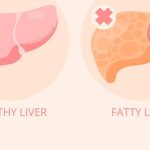 Bahaya Perlemakan Hati Fatty Liver Ancaman Senyap Yang Mengintai Kesehatan Anda