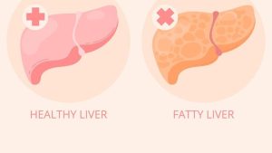 Bahaya Perlemakan Hati Fatty Liver Ancaman Senyap Yang Mengintai Kesehatan Anda