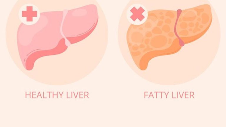 Bahaya Perlemakan Hati Fatty Liver Ancaman Senyap Yang Mengintai Kesehatan Anda