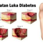 Gejala Luka Diabetes Yang Sulit Sembuh Panduan Lengkap Untuk Deteksi Dini Dan Penanganan Efektif