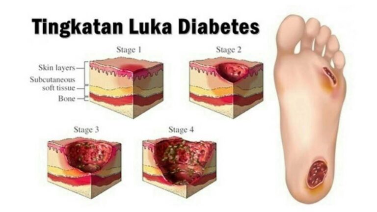 Gejala Luka Diabetes Yang Sulit Sembuh Panduan Lengkap Untuk Deteksi Dini Dan Penanganan Efektif