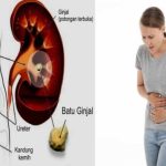 Memahami Gejala Batu Ginjal Dan Langkah Efektif Cara Pencegahannya Panduan Lengkap Untuk Kesehatan Optimal