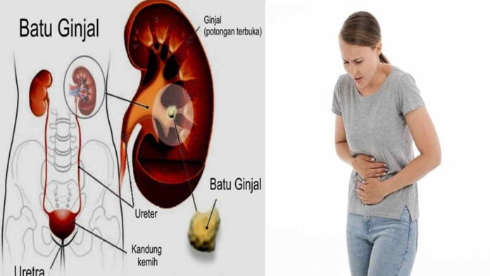 Memahami Gejala Batu Ginjal Dan Langkah Efektif Cara Pencegahannya Panduan Lengkap Untuk Kesehatan Optimal