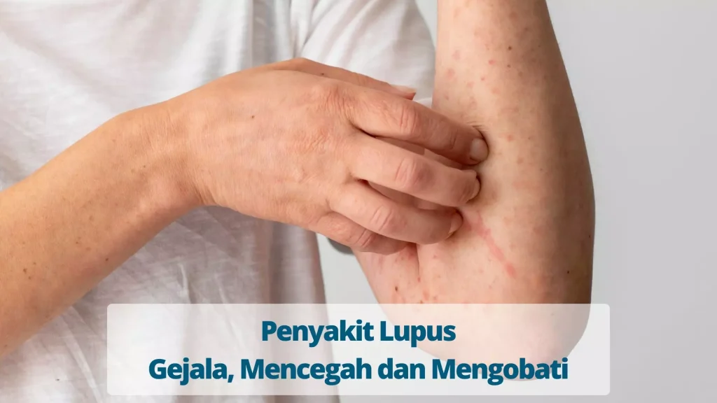 Mengenal Penyakit Lupus Gejala Dan Penanganan