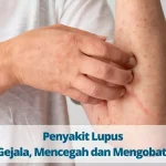 Mengenal Penyakit Lupus Gejala Dan Penanganan