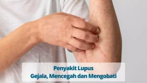 Mengenal Penyakit Lupus Gejala Dan Penanganan