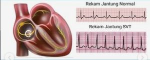 Kenapa Jantung Berdebar Cepat Setelah Lari