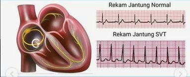 Kenapa Jantung Berdebar Cepat Setelah Lari